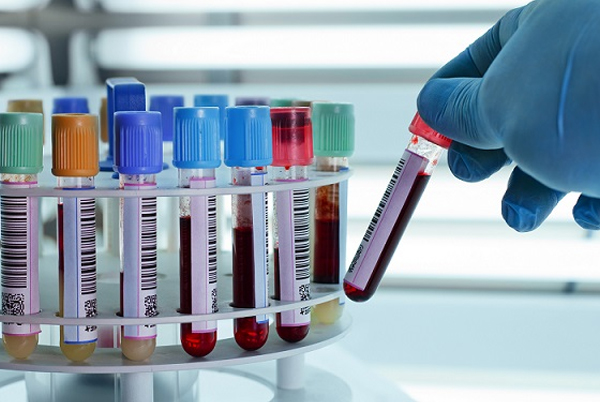 Test Name:- RUBEOLA ( MEASLES ) IgM  Test ID:- 5175845  Test Code:- RUBEOLA ( MEASLES ) IgM  Sample Type:- Swab